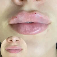 ژل لب فقط۷۷۹ \ لیزر کل بدن ۶۹۹