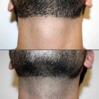 لیزر موهای زائد با دستگاه ۲۰۲۶ تضمینی معالی اباد