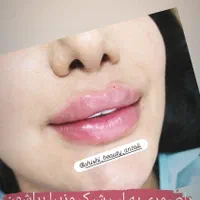 تخفیف فیلر کل صورت بجز زیر چشم سی سی1میلیون200|خدمات آرایشگری و زیبایی|بندر انزلی, چهارفریضه|دیوار