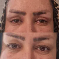 عمل افتادگی پلک/بلفاروپلاستی/اتوپلاستی(گوش)|خدمات آرایشگری و زیبایی|کازرون, |دیوار