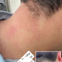 خالبرداری و فیشال درمانی تخصصی در کلینیک زیبایی