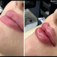 افر ویژه فیلر هر سی سی ۱۶۰۰بوتاکس ۱۶۰۰