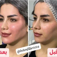 آموزش و خدمات تخصصی فیلر وبوتاکس|خدمات آموزشی|شیراز, معالیآباد|دیوار