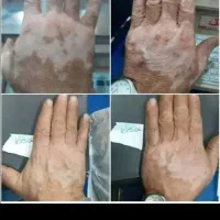 برای پیسی درمان گیاهی