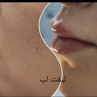 ترریق ژل و بوتاکس|خدمات آرایشگری و زیبایی|اصفهان, کوی شهید کشوری|دیوار