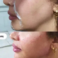 آفر ۹۰ درصدی ژل و بوتاکس و پی آر پی|خدمات زیبایی و سلامت|تبریز, |دیوار