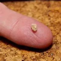 درمان سنگ کلیه