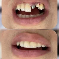 دندانپزشکی،ایمپلنت فقط ۳ میلیون