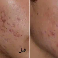 درمان جوش و جای جوش