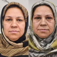عمل بینی ابدو ساکشن اسلیو لیفت شقیقه وام|خدمات آرایشگری و زیبایی|آمل, |دیوار