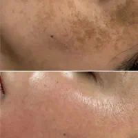 فیشیال تخصصی و درمانی فقط تا اخرشهریور تخفیف داره|خدمات آرایشگری و زیبایی|مشهد, احمدآباد|دیوار