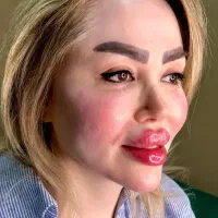 فیلر صورت خانم ها و آقایان سی سی۷۵۰