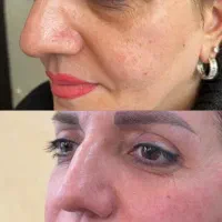 مطب تزریق ژل لب تخفیف فیلر لیفت صورت بوتاکس