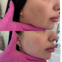 بلفاروپلاستی لیفت شقیقه بوکال فت ساکشن غبغب|خدمات آرایشگری و زیبایی|کرمانشاه, |دیوار