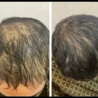 جشنواره یلدایی کاشت مو ، ابرو و مزوتراپی و prp