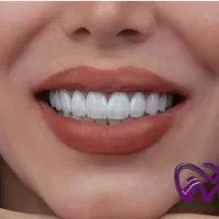 کامپوزیت دندان لبه شیشه ای اقساط بدون سود ،