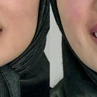 کامپوزیت دندان با قیمت باورنکردنی|خدمات آرایشگری و زیبایی|اصفهان, احمدآباد|دیوار