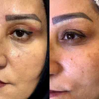 بلفاروپلاستی|خدمات آرایشگری و زیبایی|ارومیه, |دیوار