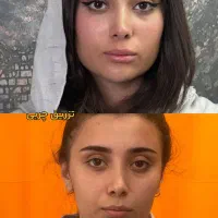 تزریق چربی، بلفارو، دایرکت ابرو، لیپوی غبغب