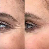 با بیوممتیک ۲۰ سال جوان شو(جایگزین بوتاکس)