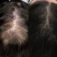 موهای پرپشت بدون کاشت