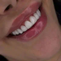 کامپوزیت دندان.دندان پزشکی