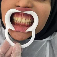 کامپوزیت، لمینت ،ایمپلنت،ارتودنسی در اقساط ۱۸ ماهه