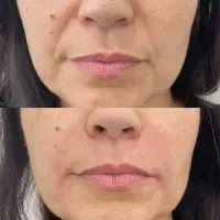 کانتورینگ لیفت فیلر بوتاکس مزو|خدمات آرایشگری و زیبایی|اصفهان, سپاهان‌شهر|دیوار