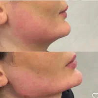 نیاز به مدل فیلر لب تزریق توسط پزشک در ستارخان