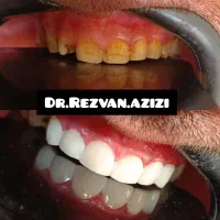 جشنواره بزرگ عصبکشی دندان برای اولین بار|خدمات آرایشگری و زیبایی|شیراز, سینما سعدی|دیوار