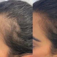 آفر20 درصد درمان قطعی ریزش مو و رویش بدون بازگشت