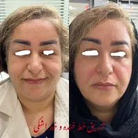 تزریق ژل فیلر بوتاکس و نخ لیفت با قیمت باورنکردنی|خدمات آرایشگری و زیبایی|رشت, گلسار|دیوار