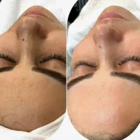 پاکسازی صورت|خدمات آرایشگری و زیبایی|زنجان, |دیوار