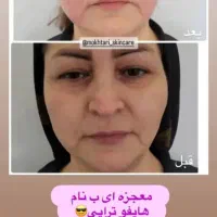 هایفوتراپی ۷بعدی تخفیف ویژه برای اولین ها|خدمات آرایشگری و زیبایی|قم, صدوق|دیوار
