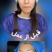 بلفاروپلاستی،سانترال لب،ساکشن غبغب،ساکشن بدن|خدمات آرایشگری و زیبایی|کرج, گوهردشت|دیوار