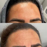 تزریق ژل و بوتاکس|خدمات آرایشگری و زیبایی|رشت, بوسار|دیوار