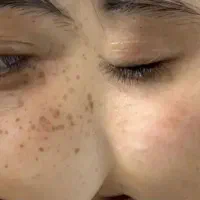 برداشتن خال.زگیل تناسلی.جای زخم و بخیه. میخچه|خدمات آرایشگری و زیبایی|کرمانشاه, |دیوار