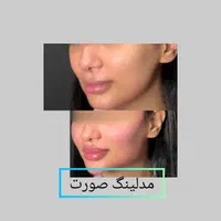 لب روسی پروفیس .جوانسازی.  پزشک|خدمات آرایشگری و زیبایی|اهواز, زیتون کارمندی|دیوار