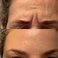 خدمات ژل و بوتاکس در منزل شما