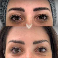 جشنواره تخفیفی لیپوماتیک بلفاروپلاستی و لیپوبازو|خدمات آرایشگری و زیبایی|تهران, ونک|دیوار