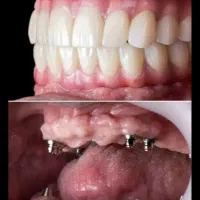 ایمپلنت دیجیتال اقساطی، کیفیتی که حس می‌کنی