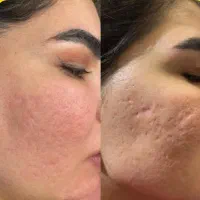 پی ار پی مزونیدلینگ سابسیژن لک جای جوش پی ارپیPRP