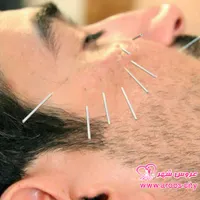 دوره تخصصی طب سوزنی با ارائه مدرک بین‌المللی|خدمات آموزشی|تهران, پیروزی|دیوار