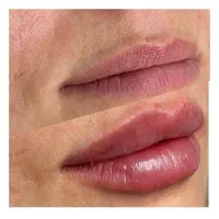 تزریق ژل بوتاکس مزو فیلر و...در شیراز،صدرا وگلستان