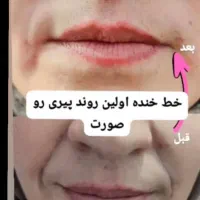 اف تابستانه زیبایی تزریق ژل، بوتاکس، پی ار پی|خدمات آرایشگری و زیبایی|اهواز, کمپلو جنوبی|دیوار