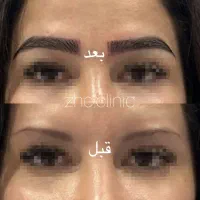 کاشت ابرو فقط ۱۴۹۰۰ با دو جلسه مزو رایگان|خدمات آرایشگری و زیبایی|مشهد, طلاب|دیوار
