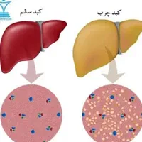 کبدچرب/کیست فیبروم /تنبلی تخمدان/تیروئید