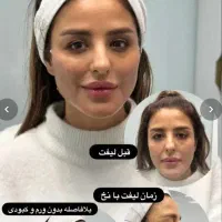 لیفت تخصصی صورت ،بینی ،ابرو و شقیقه با نخ امریکایی