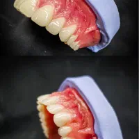 دست دندان مصنوعی( پروتز متحرک)