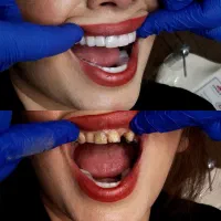 انجام لمینت متحرک دندان|خدمات آرایشگری و زیبایی|تهران, تهرانپارس غربی|دیوار